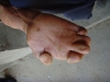 Effect of leprosy