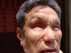 Eyes effected by leprosy